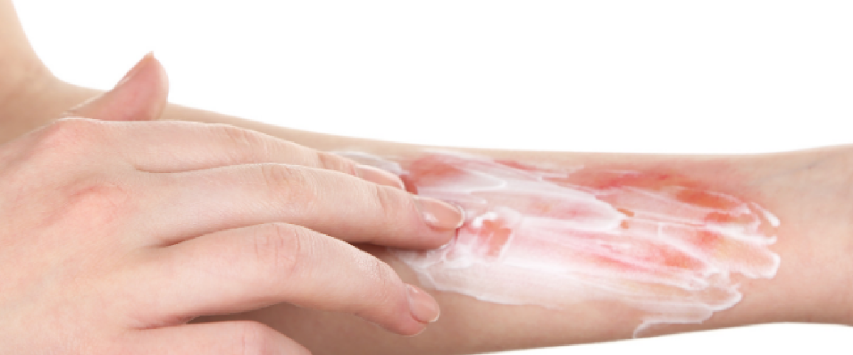 از بین بردن جای سوختگی با وازلین